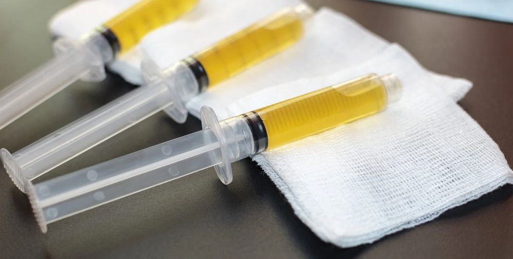 Syringes of platelet-rich plasma